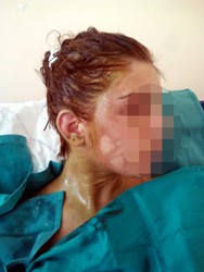 SİNOP’LU ÜNİVERSİTELİ GENÇ KIZA ASİTLİ SALDIRI 