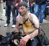 KENDİNİ ATEŞE VEREN VATANDAŞ HAYATINI KAYBETTİ